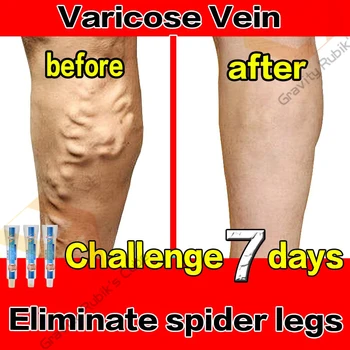 Creme eficaz do alívio da veia varicosa da pomada para aliviar o tratamento da dor da aranha da vasculite phlebite